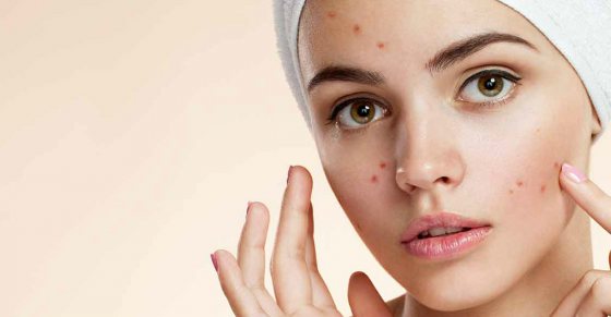 Surprising Home Remedies for Acne